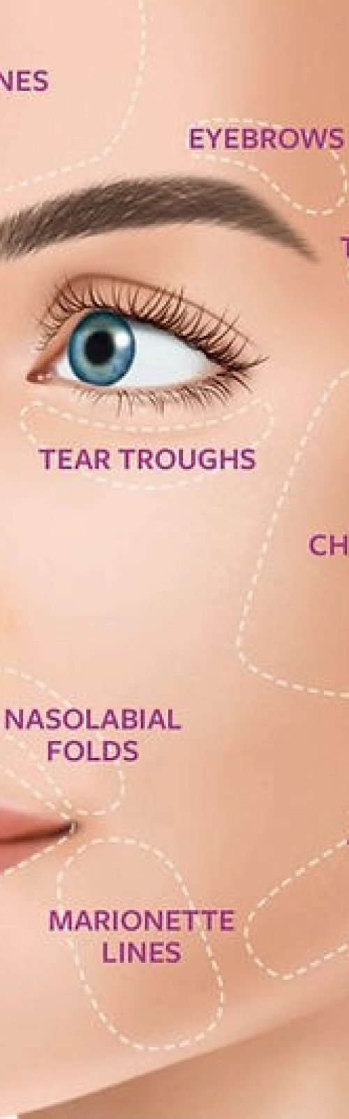 dermal filler areas